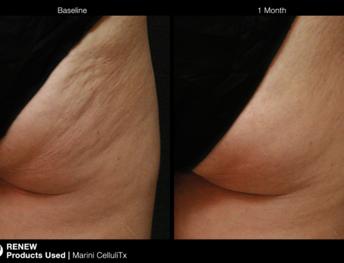 Cellulite – need I say more?
